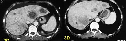 Tratamentul metastazelor în medicamentul folic ficat
