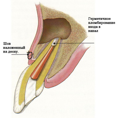 Tratamentul parodontitei (repetarea canalelor)
