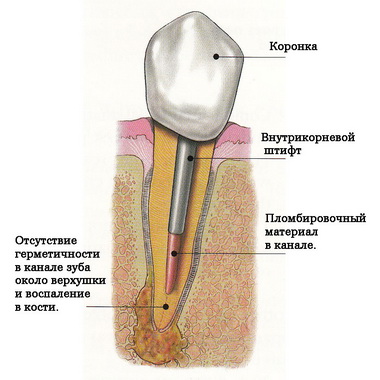 Tratamentul parodontitei (repetarea canalelor)