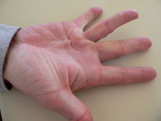 Betegségek kezelési, a szalagok és inak a kéz - a klinikán Dr. Merker