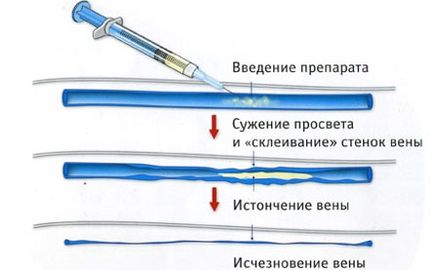 Лопаються судини на ногах і з'являються синці причини, як лікувати, ефективні процедури