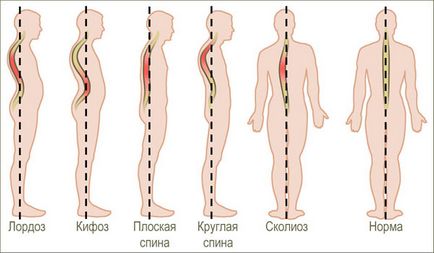 Lordoza coloanei vertebrale toracice, simptome, cauze, tratament