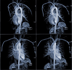 Imagistica prin rezonanță magnetică a inimii