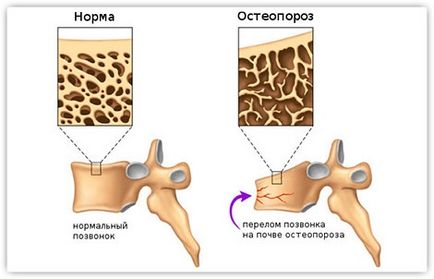 Менопаузальний і постменопаузальний остеопороз