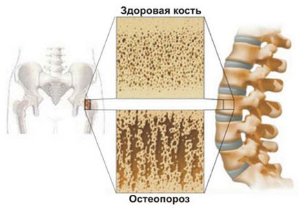 Menopauză și osteoporoză postmenopauză