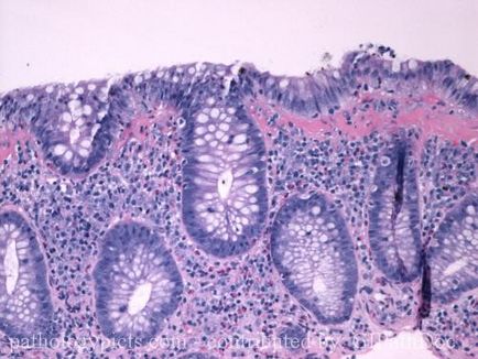 Colită microscopică și patologia acesteia