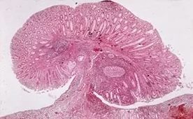 Colită microscopică și patologia acesteia