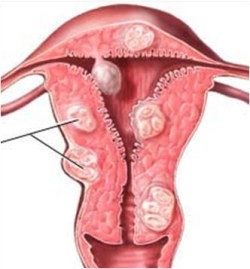 Fibrele uterine folclorice