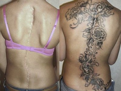 Pot să fac tatuaje pe cariere, cicatrici și site-ul acnei despre tatuaje