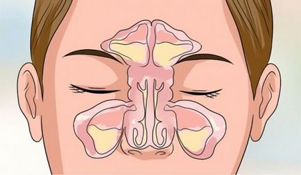 Coryza 6 sfaturi simple pentru a vă curăța nasul de mucus