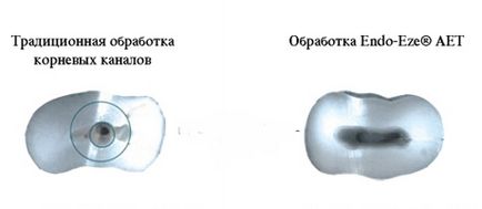 Un nou concept în endodonție - sistemul endo-eze aet - terapie - știri și articole despre stomatologie -