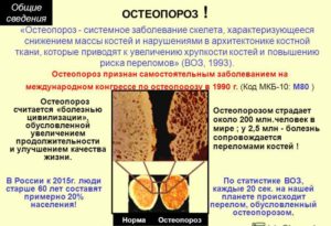 Остеопороз ніг ознаки, симптоми і лікування