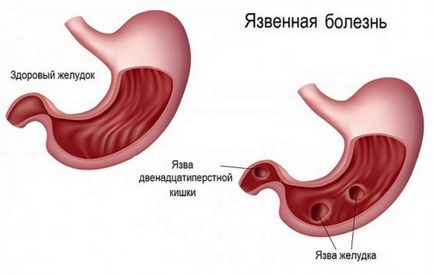 Simptome ulceroase ale stomacului acut, tratament, dietă