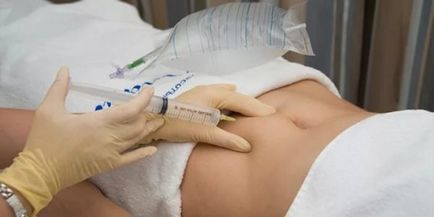 Озонотерапія для схуднення суть процедури, ефективність, відгуки лікарів і тих, що худнуть, фото до і після