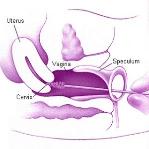 Testul Papanicolau și cancerul de col uterin