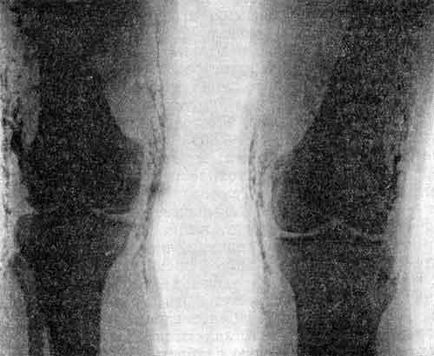 Parézis és az izom meszesedések - dermatomyositis - kollagén betegségek klinikán - orvosi szerver