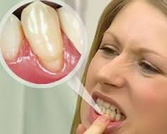 Пародонтит симптоми, етіологія і патогенез - можливо кращий сайт про лікування зубів