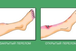 Fractura piciorului pentru siguranțe de durată - care este dislocarea de la a la