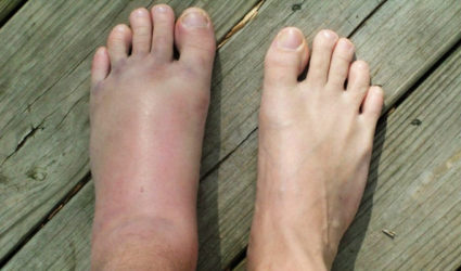Törés a lábközépcsont csont a láb - Tünetek, kezelés és rehabilitáció
