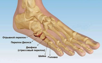 Törés a lábközépcsont csont a láb - Tünetek, kezelés és rehabilitáció