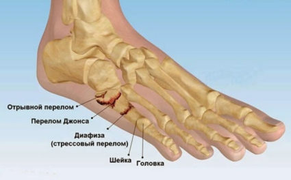 Перелом плеснової кістки стопи - симптоми, лікування і реабілітація