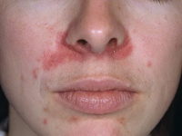Пероральний дерматит на обличчі симптоми, лікування, фото