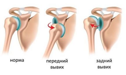 Чому болить плече при піднятті руки вгору лікування Наодном засобами і причини