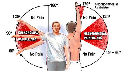 Чому болить плече при піднятті руки вгору лікування Наодном засобами і причини