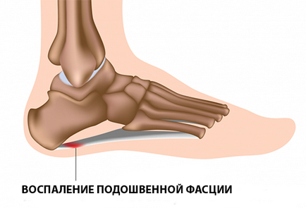 Підошовний фасциит симптоми, причини, лікування, методи профілактики