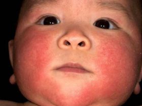 Почервоніння при алергії і асептичне запалення