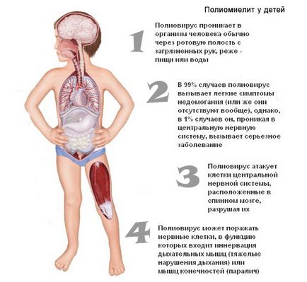 Поліомієліт симптоми, небезпека, щеплення від поліомієліту як єдиний засіб профілактики