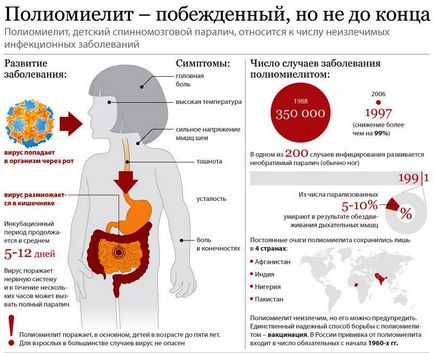 Поліомієліт симптоми, небезпека, щеплення від поліомієліту як єдиний засіб профілактики