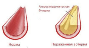 Чи допомагає яблучний оцет при варикозі, і як правильно його використовувати