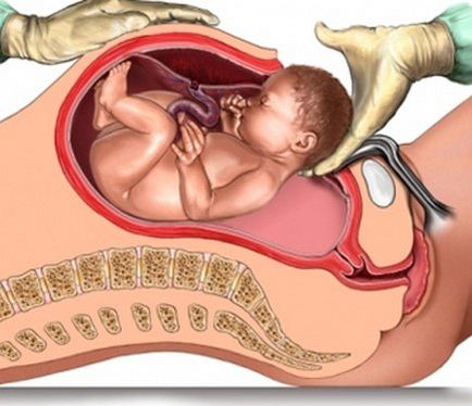 Praevia és kóros helyét a placenta a terhesség alatt - mit fenyeget, és mit kell tenni
