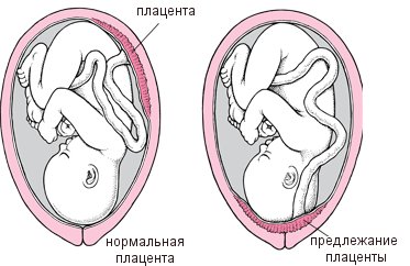 Praevia és kóros helyét a placenta a terhesség alatt - mit fenyeget, és mit kell tenni