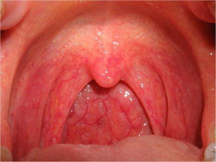 Cauzele și tratamentul faringitei granulozei