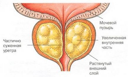 Prostatita ce este?