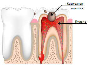 Pulpita - cauze, simptome și remedii folclorice pentru pulpită