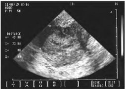 Cancerul endometrial