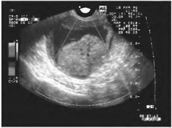 Cancerul endometrial