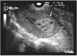 Cancerul endometrial