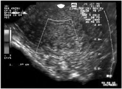 Cancerul endometrial