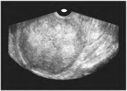 Cancerul endometrial