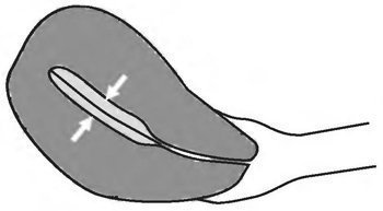 Cancerul endometrial