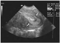 Cancerul endometrial