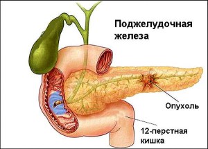 Рак позапечінкових жовчних шляхів