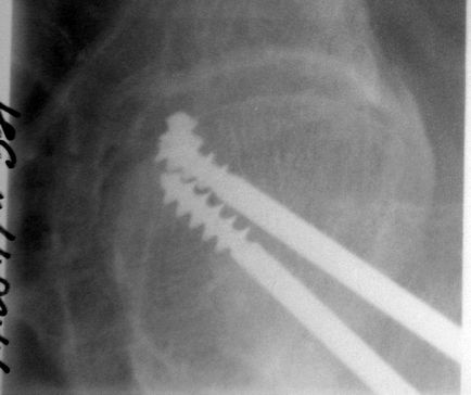 Рентгенограми тазостегнового суглоба під скопически контролем