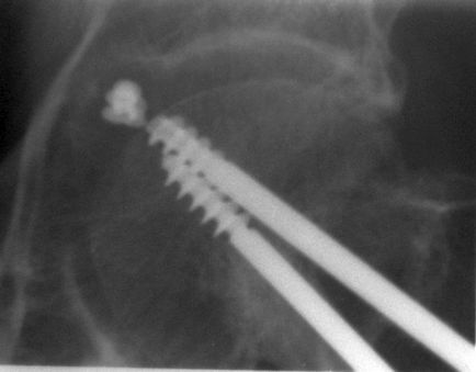 Radiografia articulației șoldului sub controlul skypic