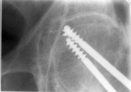 Radiografia articulației șoldului sub controlul skypic