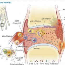 Ревматоїдний артрит